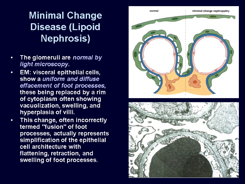 Minimal Change Disease (Lipoid Nephrosis) The glomeruli are normal by light microscopy.  EM: